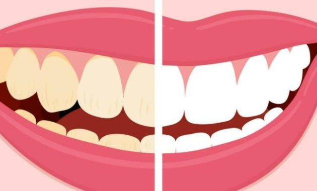 Can food coloring stain your teeth