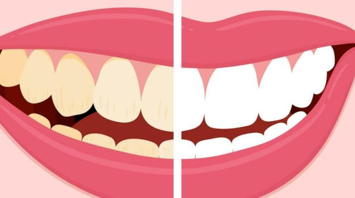 Can food coloring stain your teeth